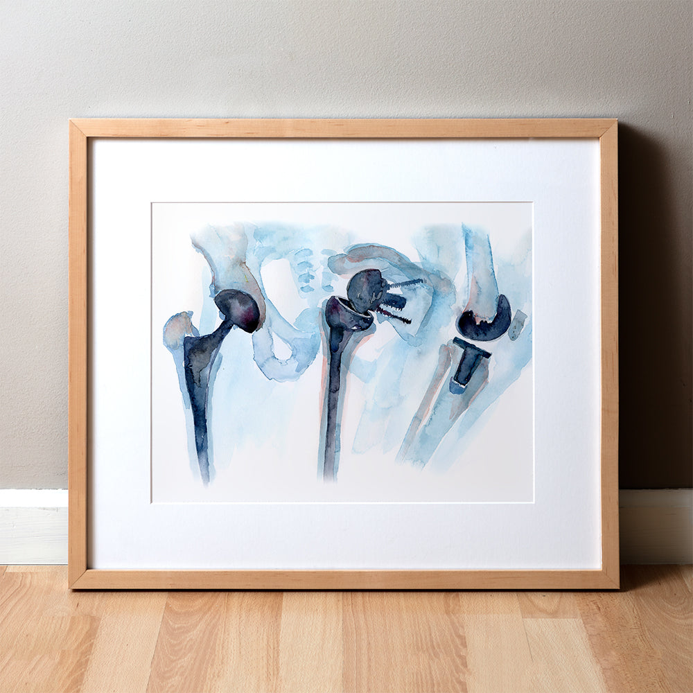 Framed watercolor painting of a hip, shoulder, and knee with orthopedic implants. 