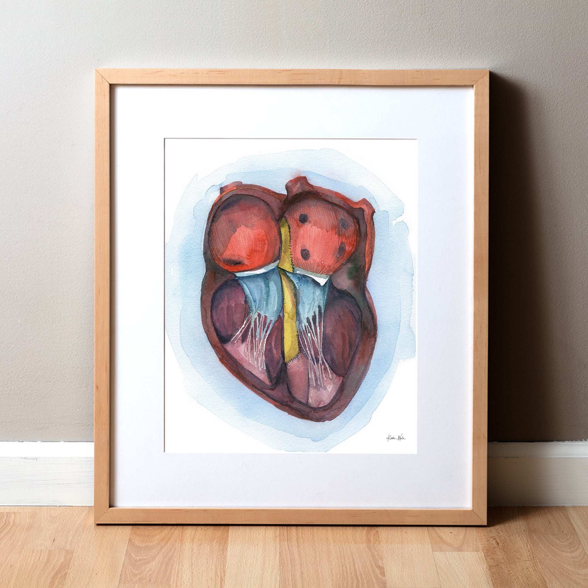 AVSD Down Syndrome Heart Watercolor Print