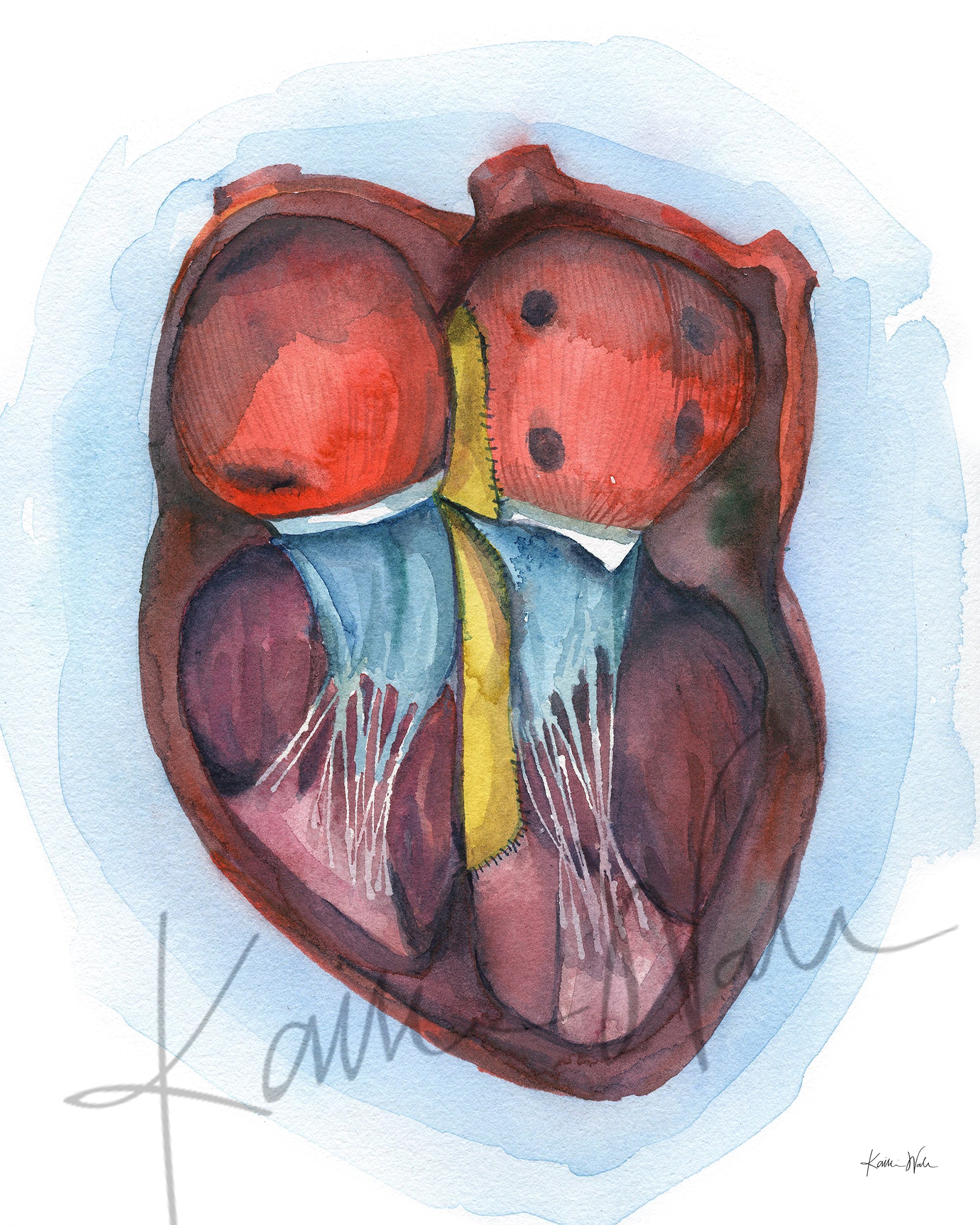 AVSD Down Syndrome Heart Watercolor Print