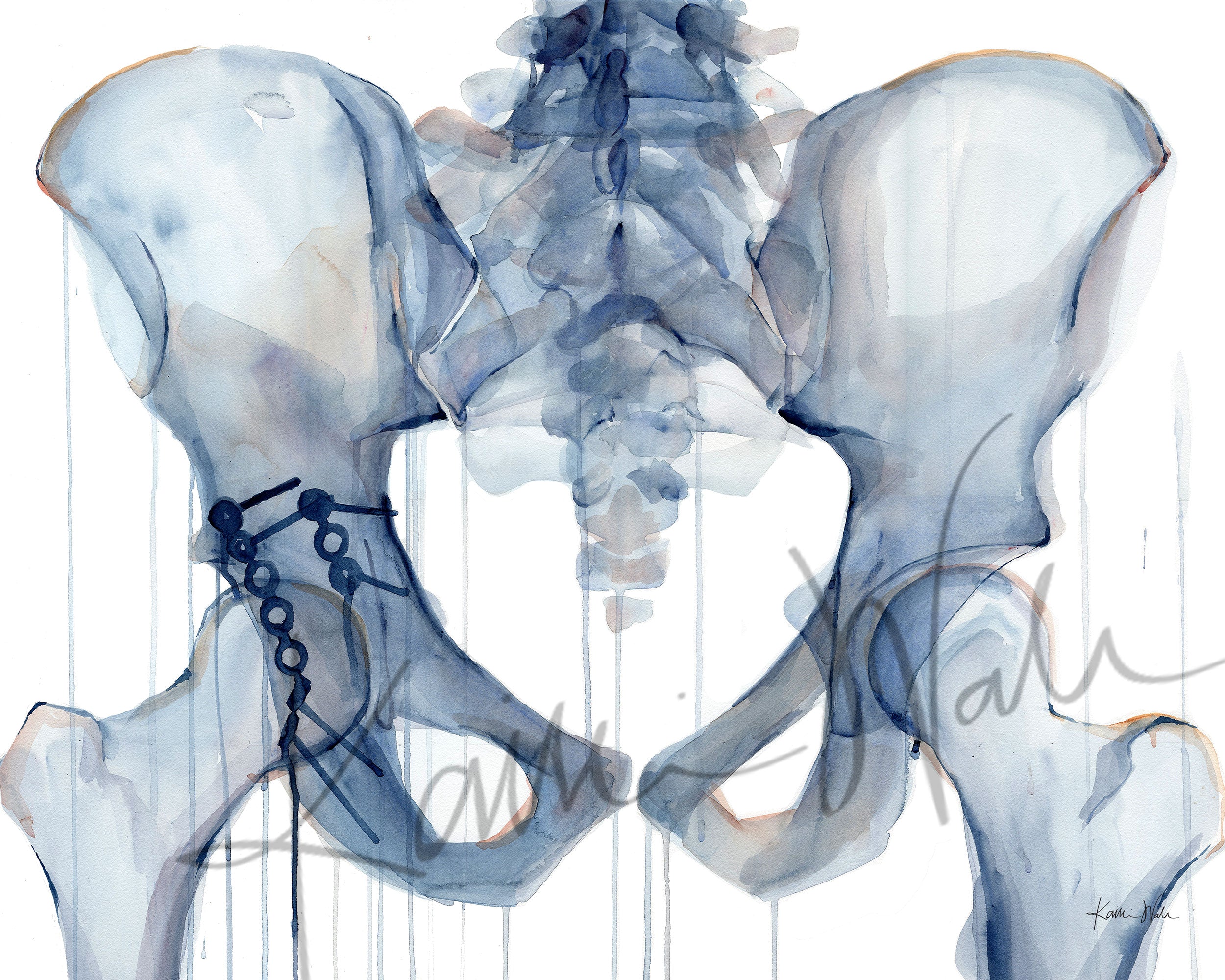 Unframed watercolor painting of a hip repair with pinning.