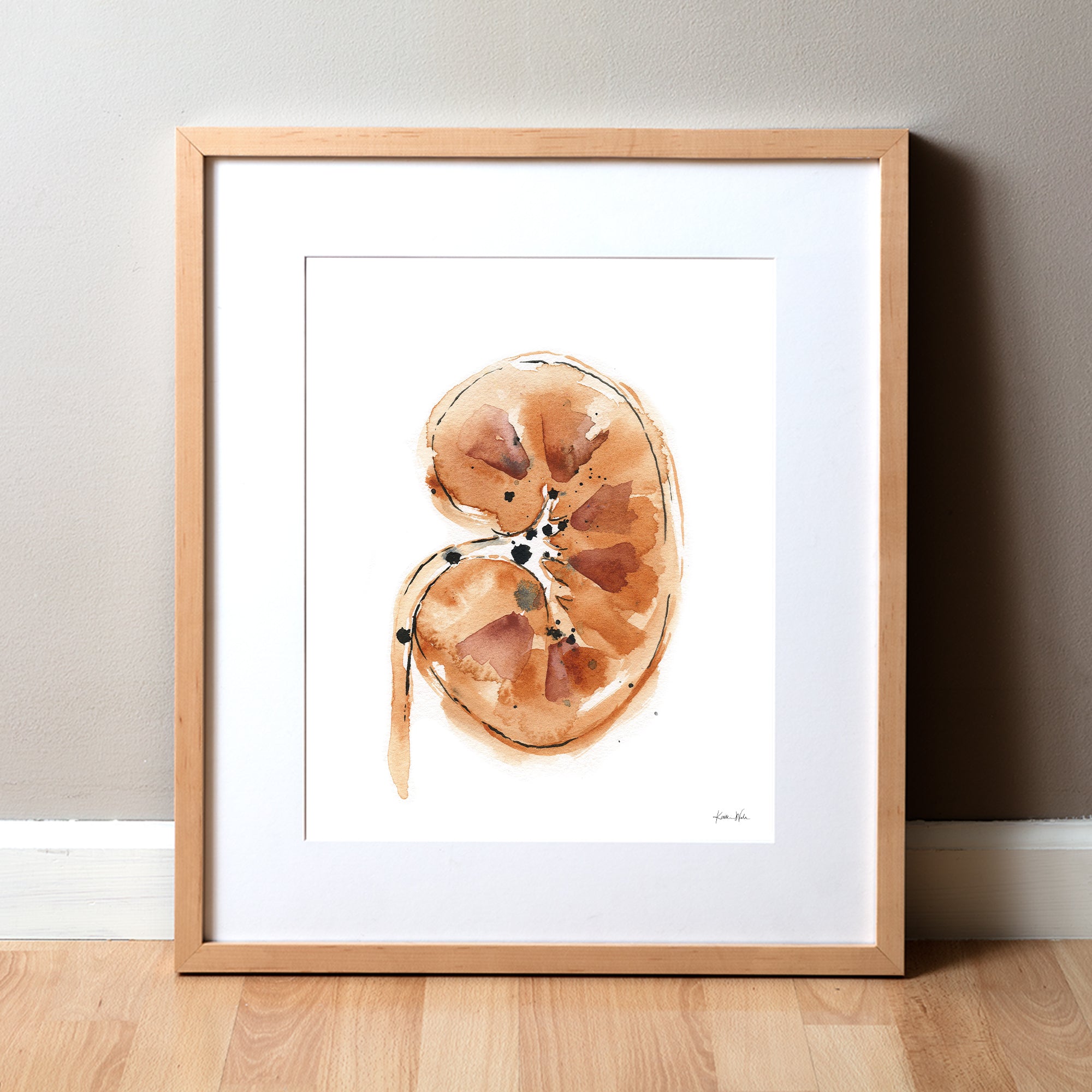 Kidney Stones Watercolor Print