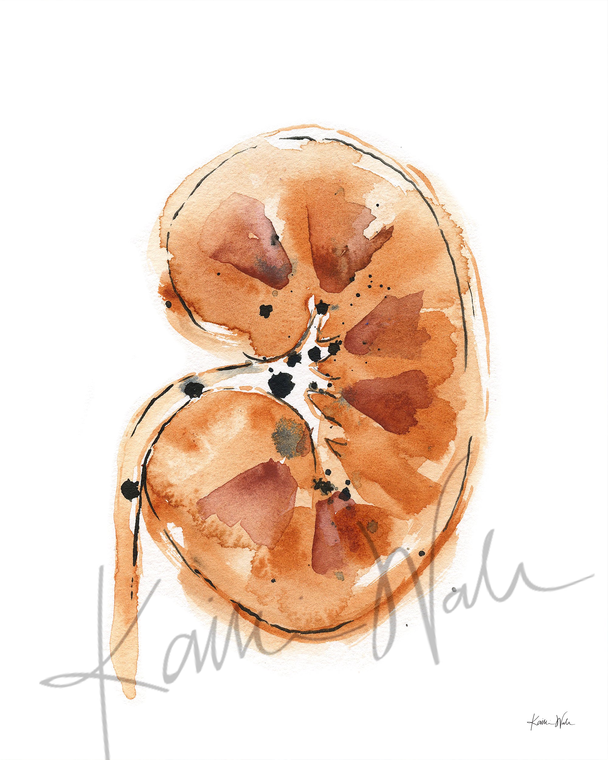 Kidney Stones Watercolor Print