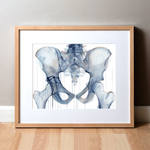 Framed watercolor painting of a hip repair with pinning.