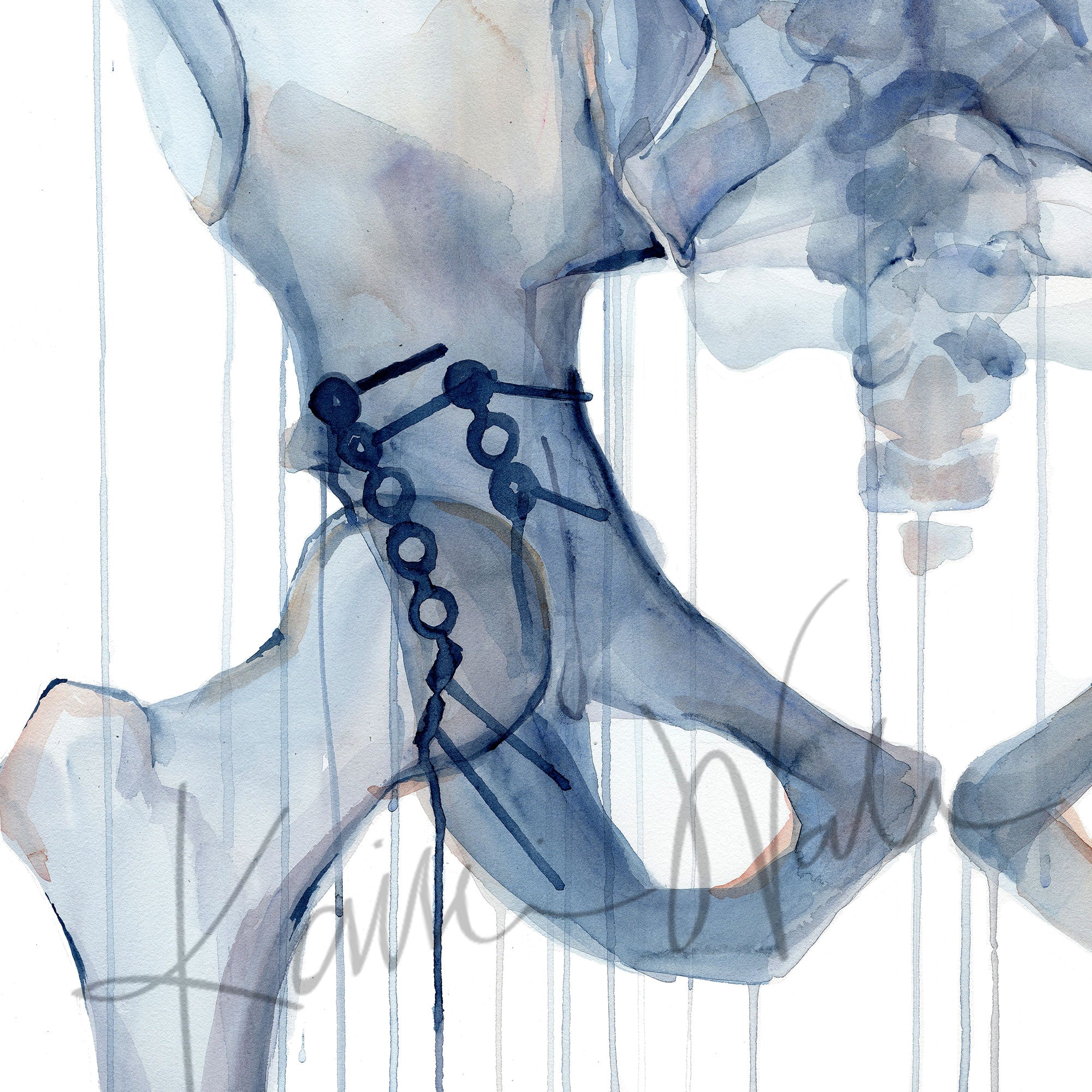 Zoomed in view of a watercolor painting of a hip repair with pinning.