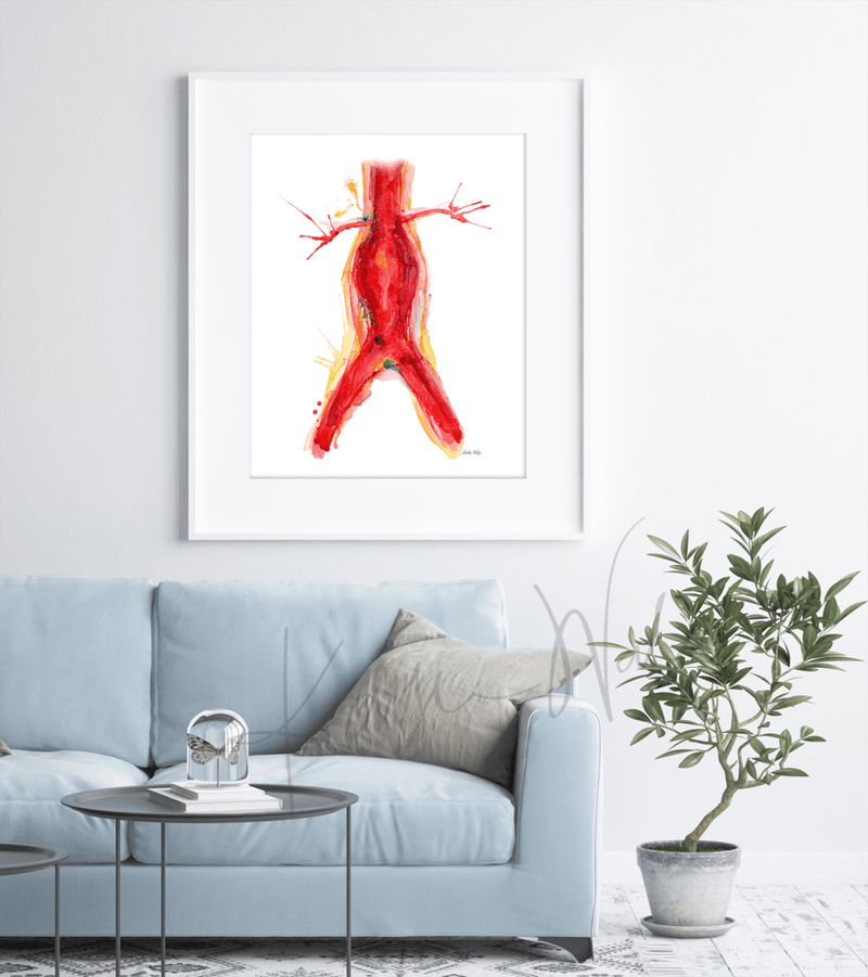 Abdominal Aneurysm Print Watercolor- Clinic Art- Doctor's Office Art- Clinic Decor - Anatomy Art