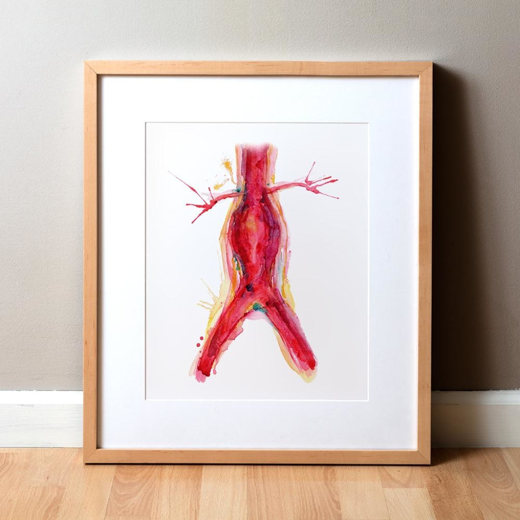 Abdominal Aneurysm Print Watercolor