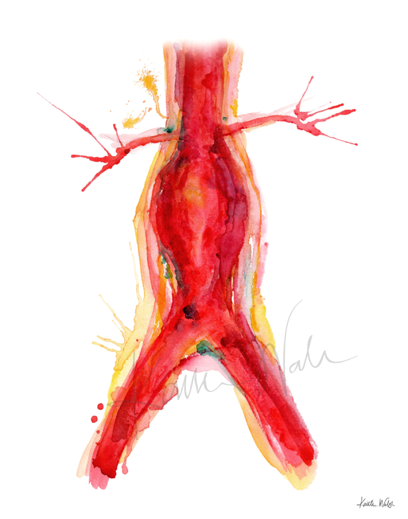 Cardiovascular Print Set Watercolor- Abdominal Aneurysm - Cardiovascular medical 