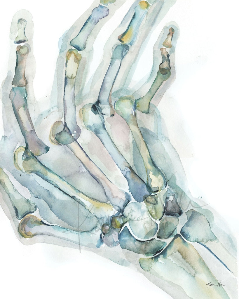 Rheumatoid Arthritis(Ra) Of The Hand Watercolor Print