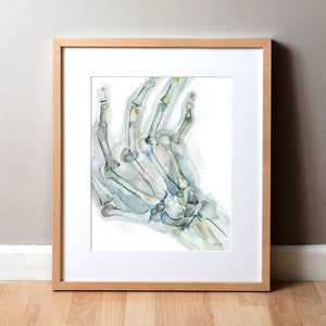 Rheumatoid Arthritis(Ra) Of The Hand Watercolor Print