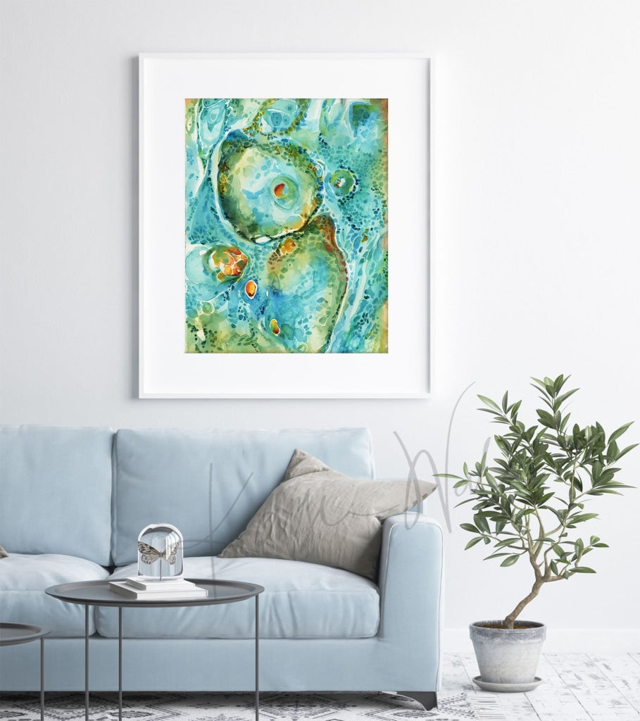 Basal Cell Carcinoma Watercolor Print