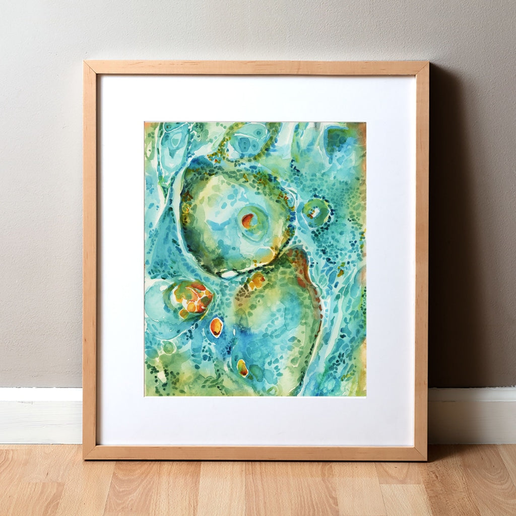 Basal Cell Carcinoma Watercolor Print