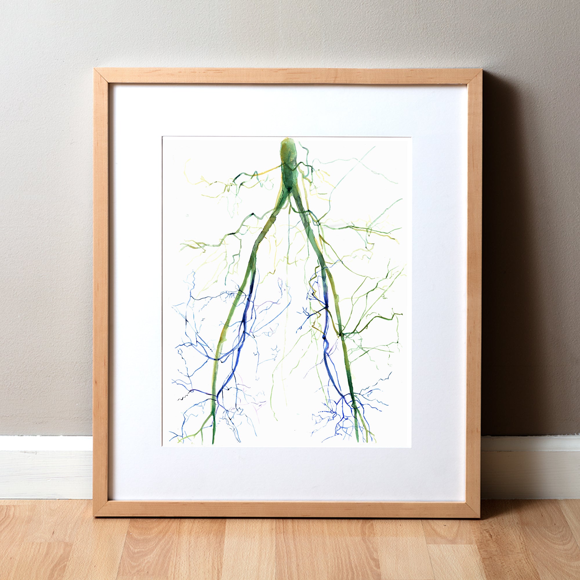 Framed watercolor painting of two angiograms combined into one. The painting shows the before of a blocked iliac artery and an after, unblocked iliac artery.