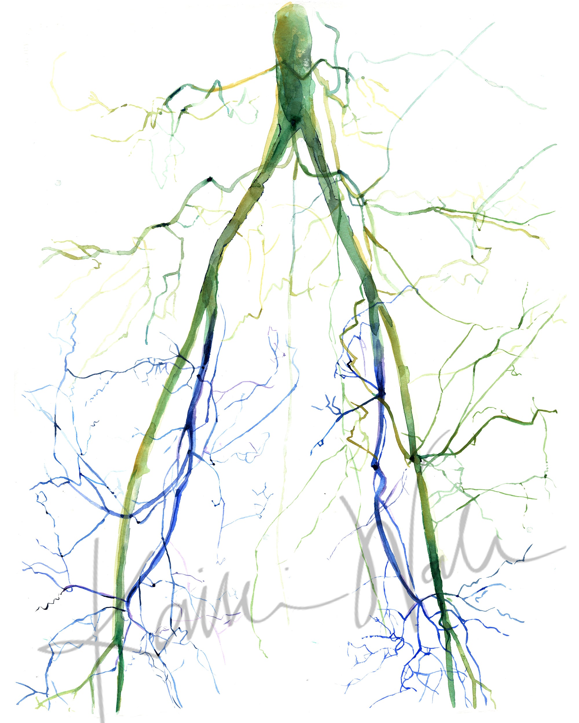 Unframed watercolor painting of two angiograms combined into one. The painting shows the before of a blocked iliac artery and an after, unblocked iliac artery.