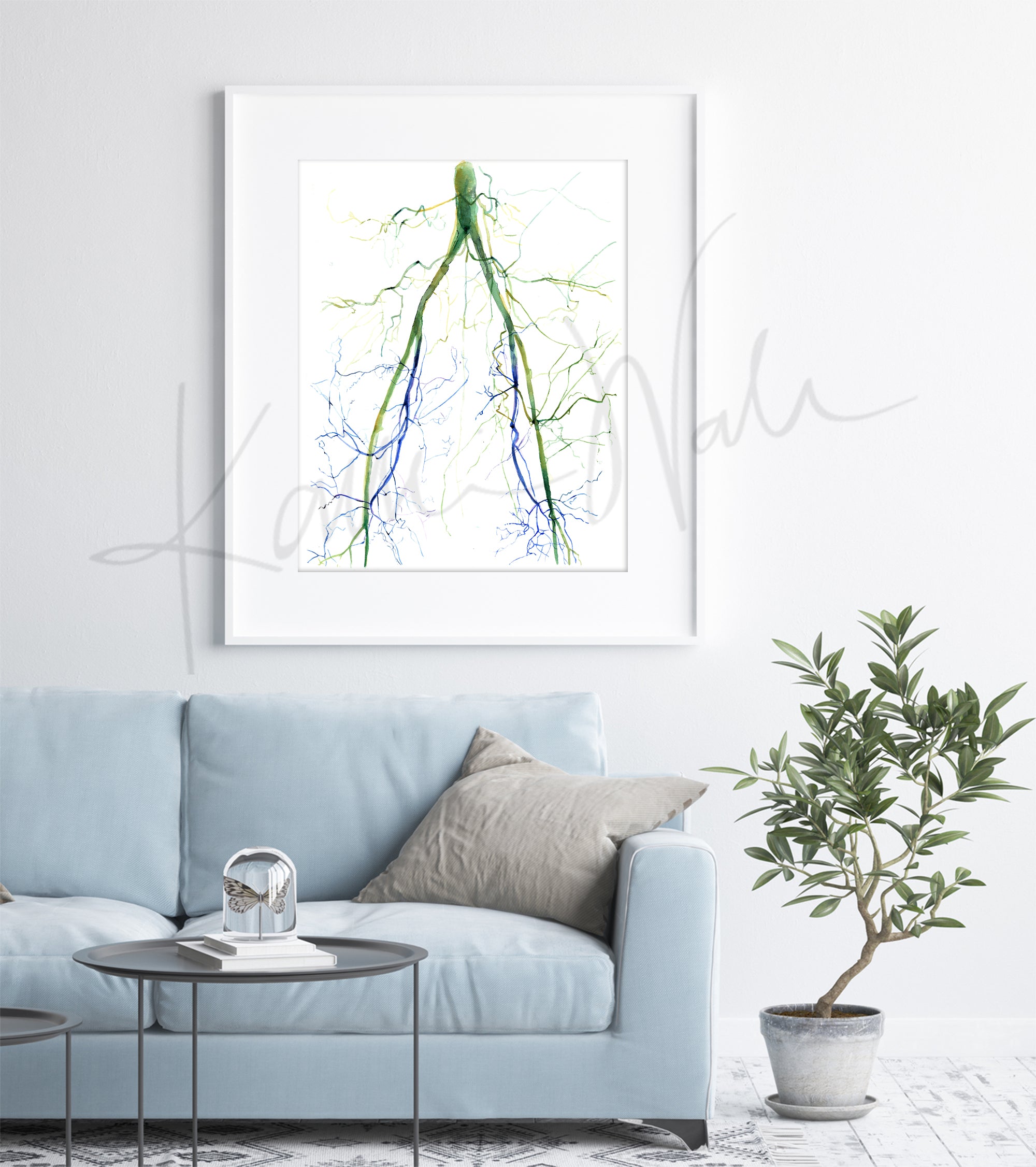 Framed watercolor painting of two angiograms combined into one. The painting shows the before of a blocked iliac artery and an after, unblocked iliac artery. The painting is hanging over a blue couch.