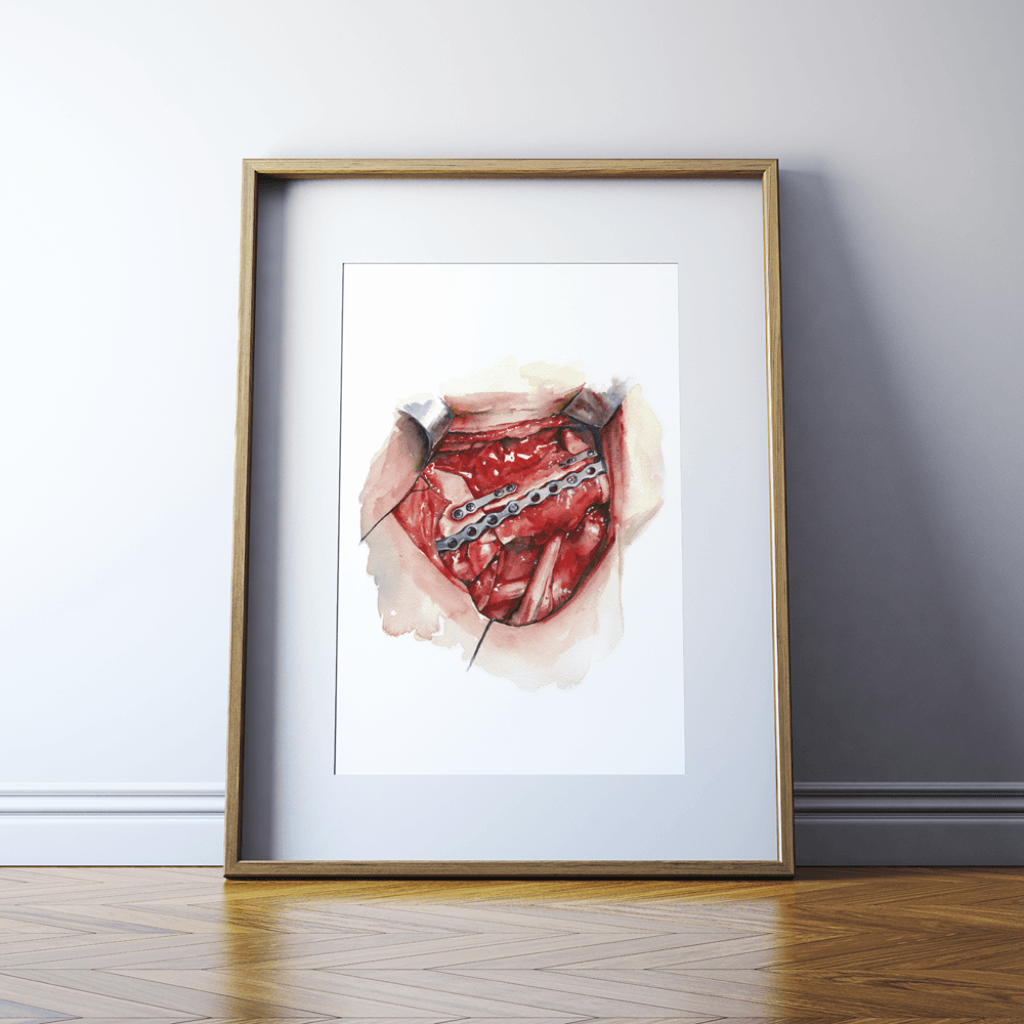 Neck Dissection I Print Watercolor- anatomy art- surgery art- gift for surgeon- gift for doctor- Cancer surgery art painting