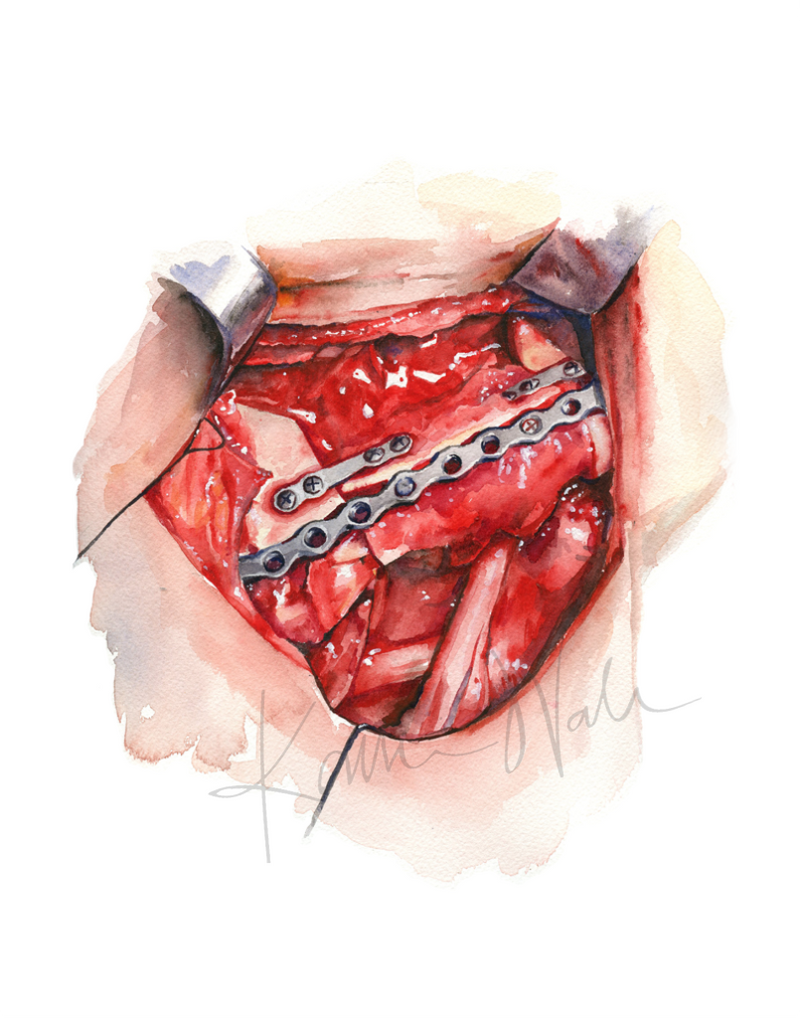 Neck Dissection I Print Watercolor- anatomy art- surgery art- head surgery- neck srugery- neck cancer