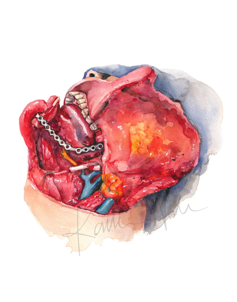 Neck Dissection Ii Print Watercolor