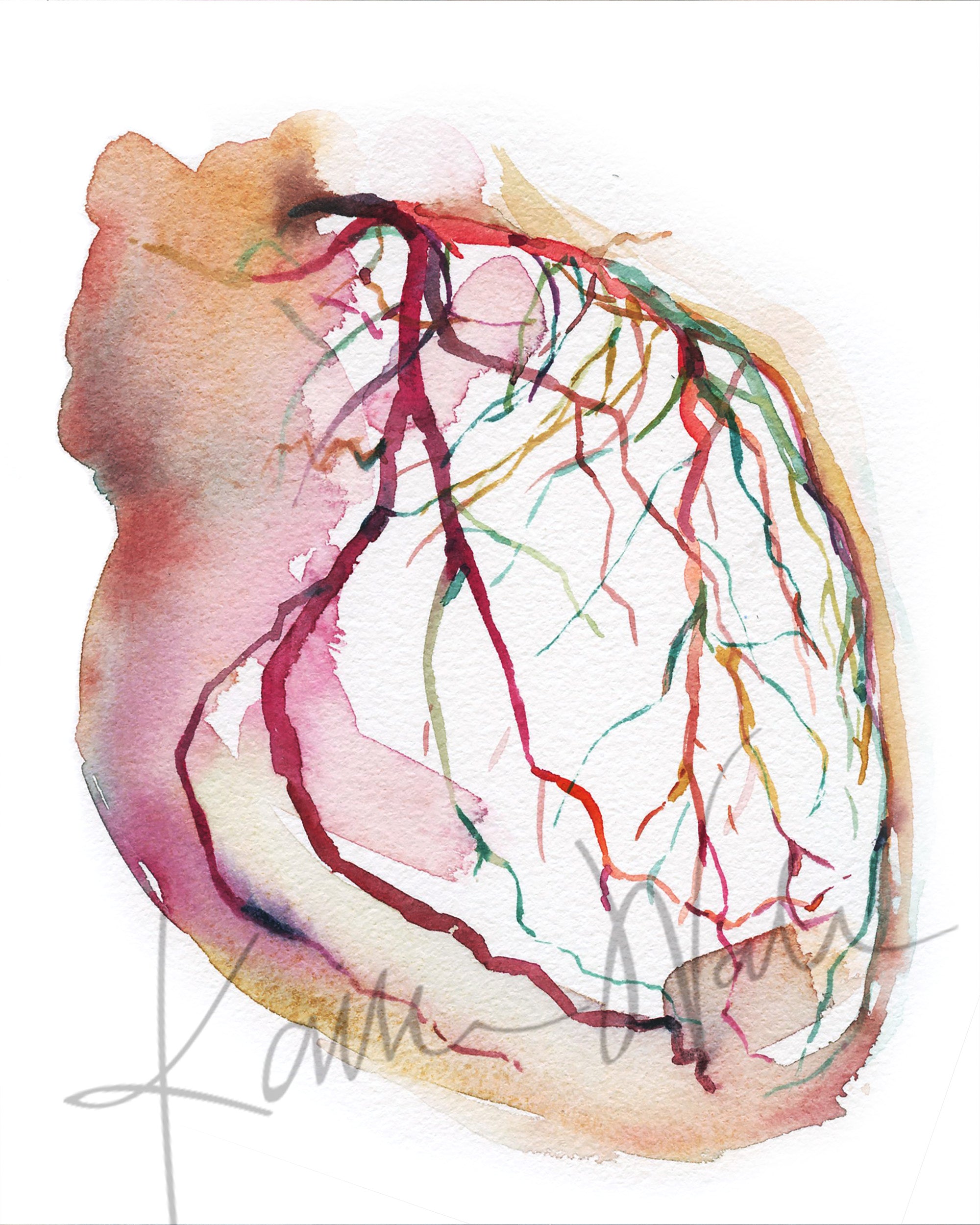  Unframed watercolor painting showing a coronary angiogram x-ray image in reds, purples, greens, oranges and yellows