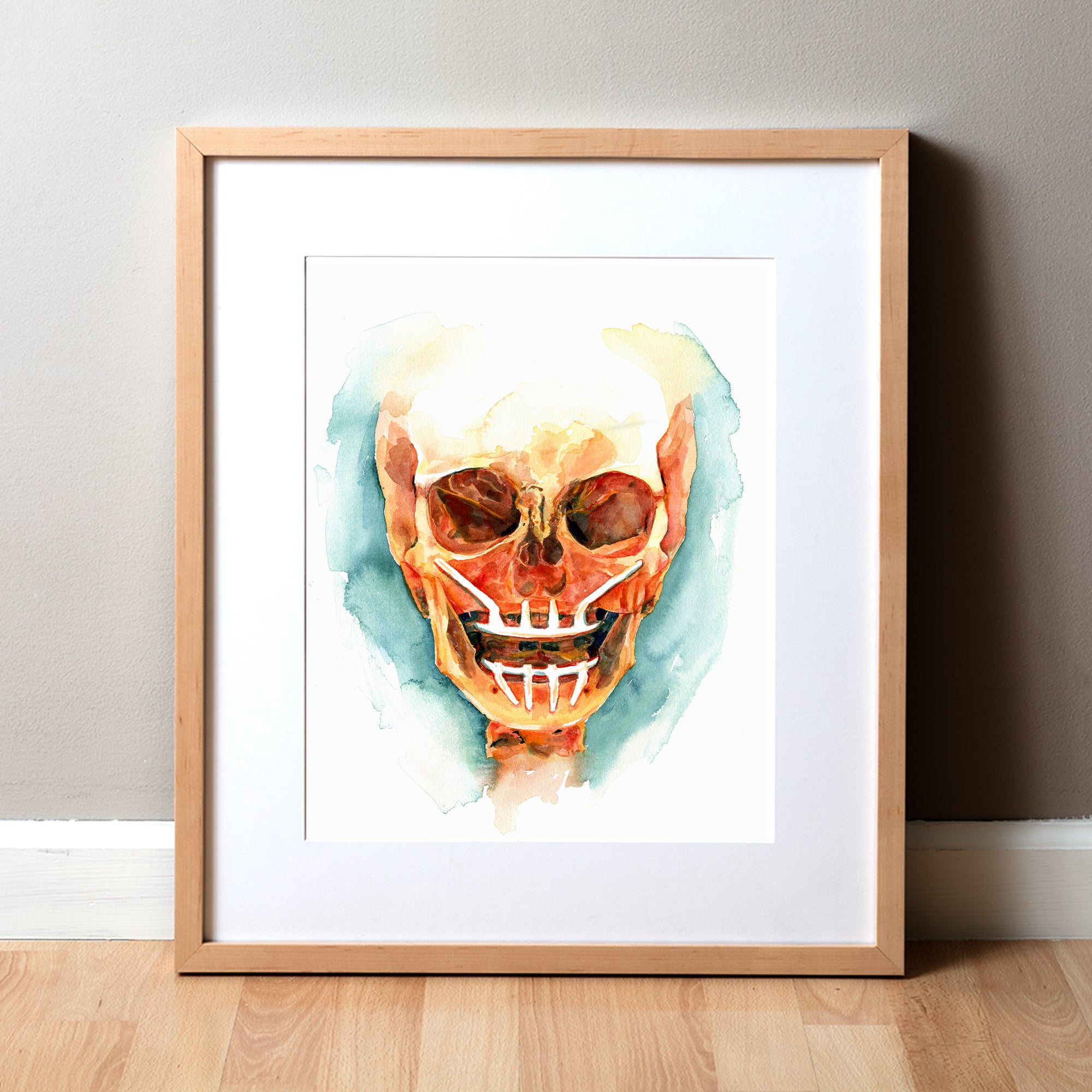 Framed watercolor painting of a mandibular and maxillary all on 4 with two anterior implants and 2 zygomatic implants.