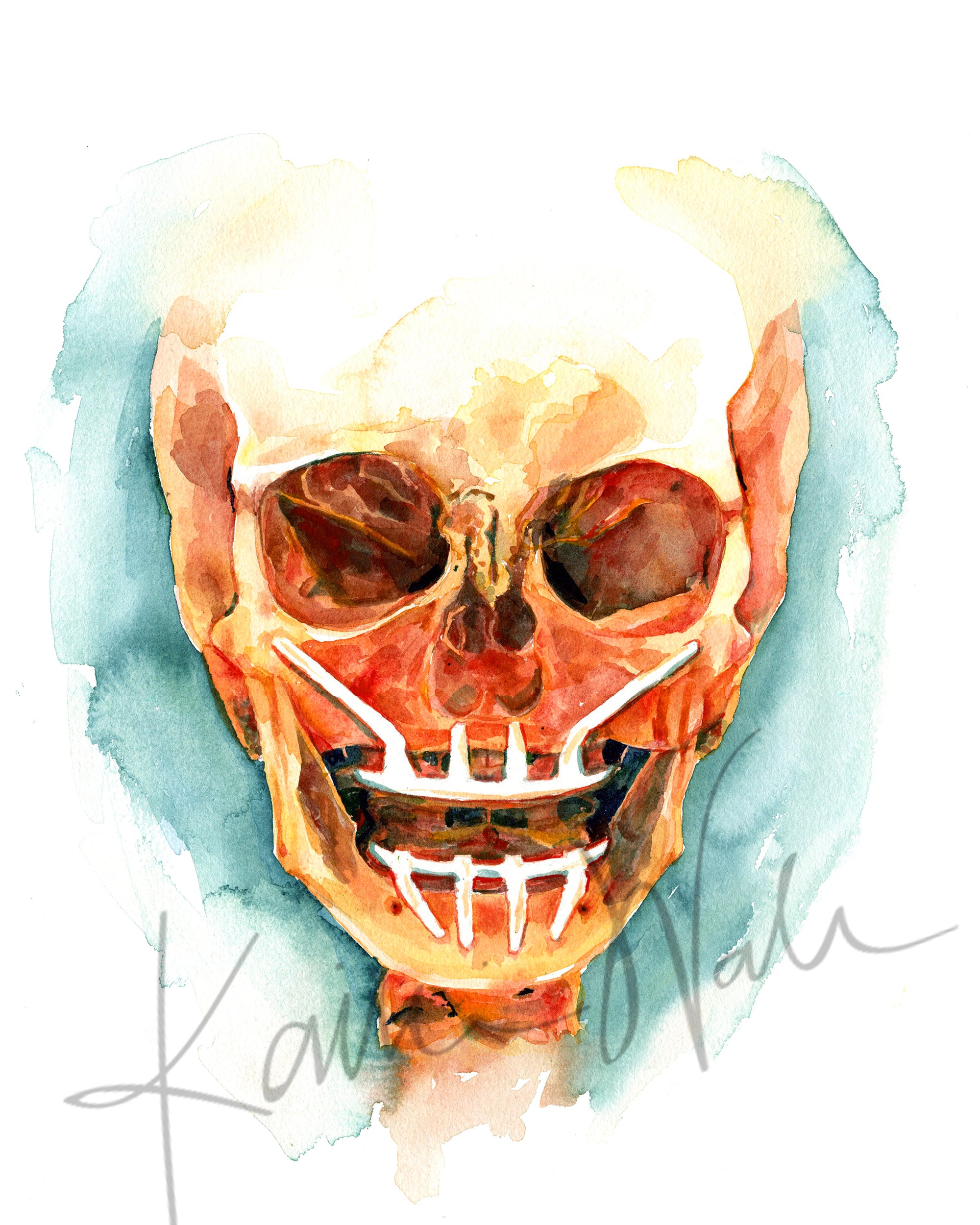 Unframed watercolor painting of a mandibular and maxillary all on 4 with two anterior implants and 2 zygomatic implants.