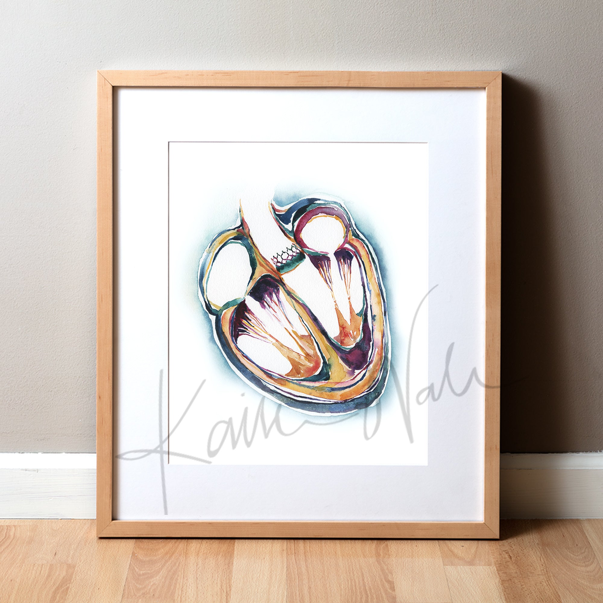 Heart Valve Replacement Watercolor Print