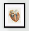 Hypertrophic Cardiomyopathy Heart Watercolor - Original