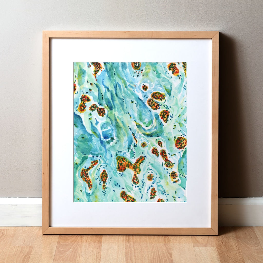 Melanoma Watercolor Print