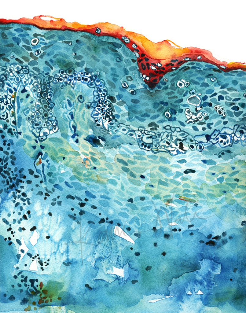 Melanoma Watercolor Print