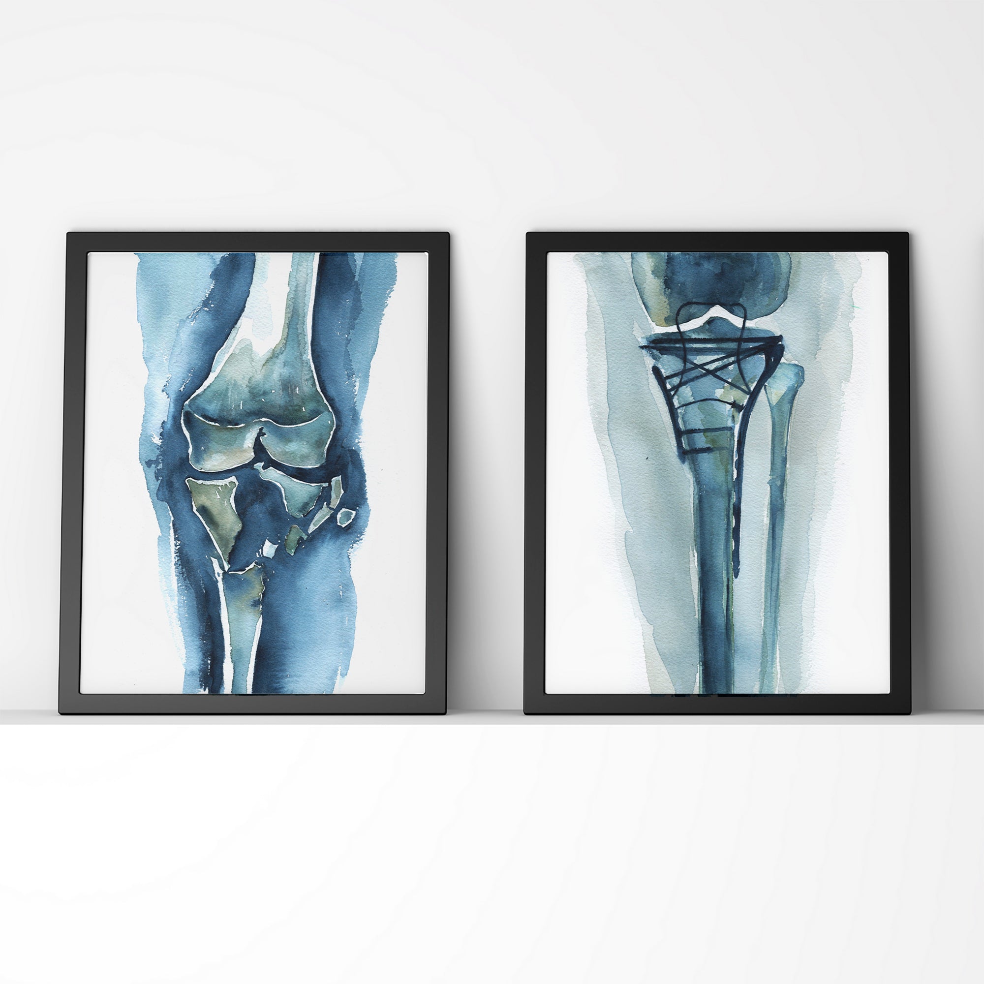 Framed watercolor paintings of a before and after of a shattered knee and the hardware used to fix it.