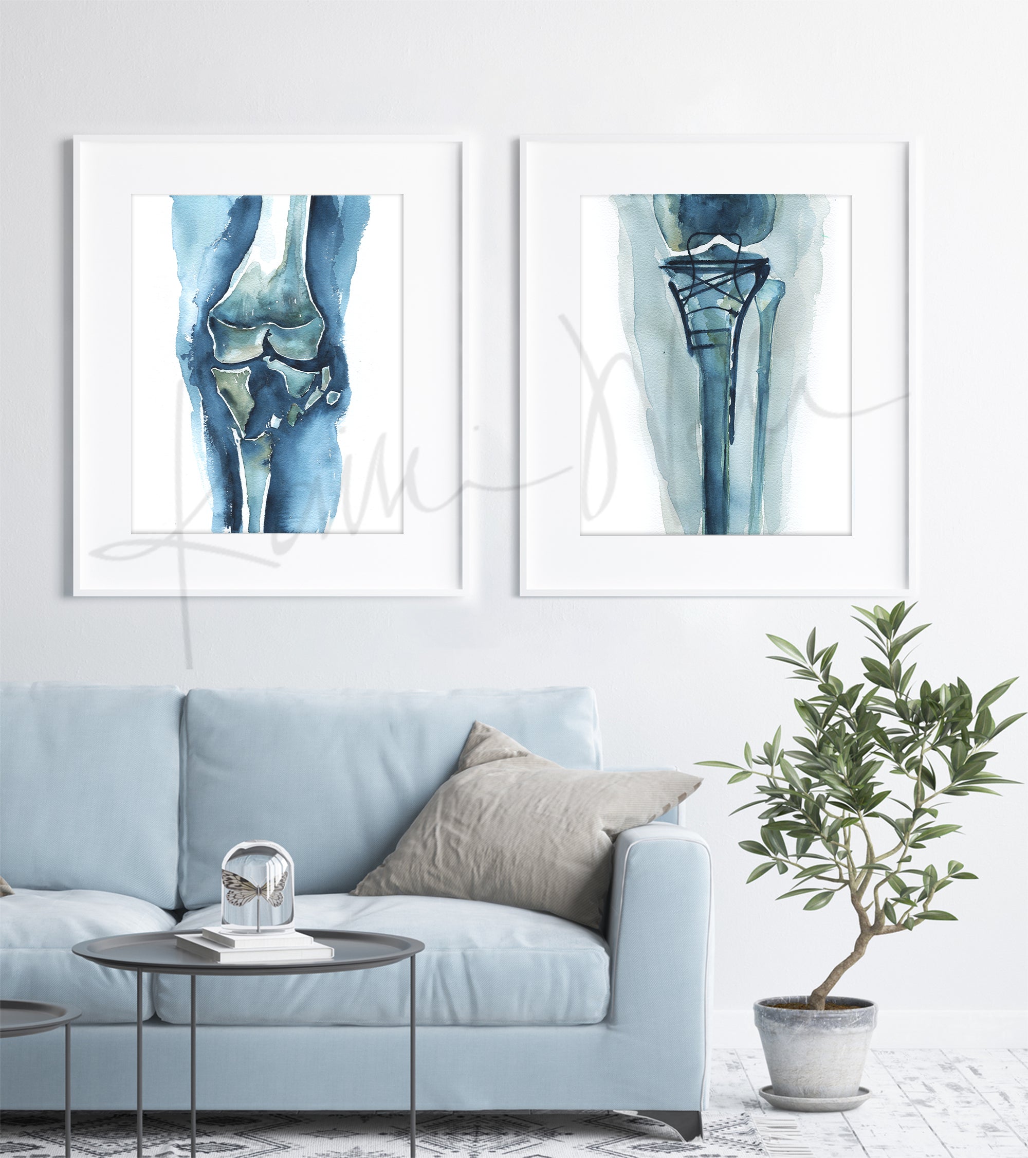 Framed watercolor painting of a before and after of a shattered knee and the hardware used to fix it. The paintings are hanging over a blue couch.