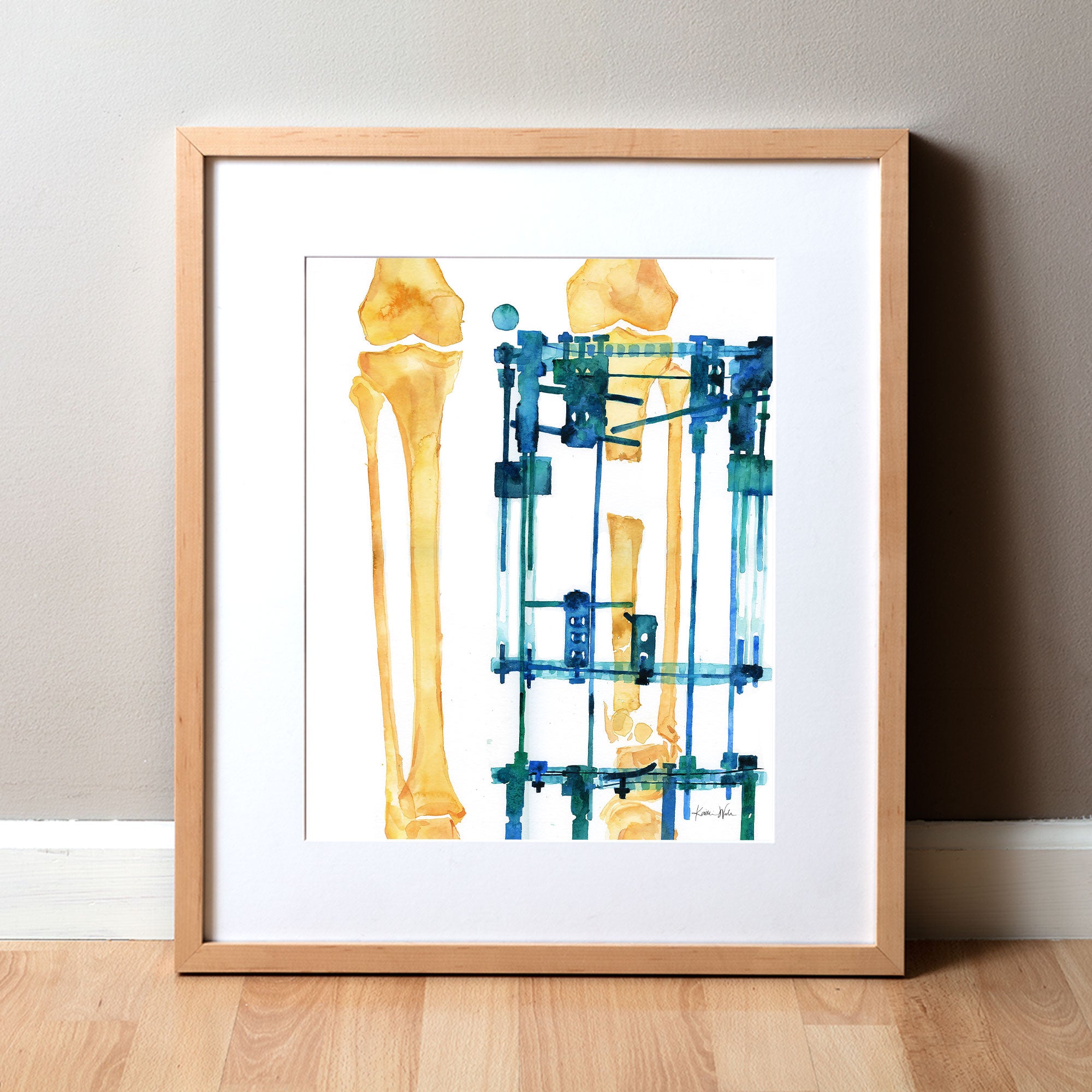 Framed watercolor painting of a post orthopedic surgery x-ray.