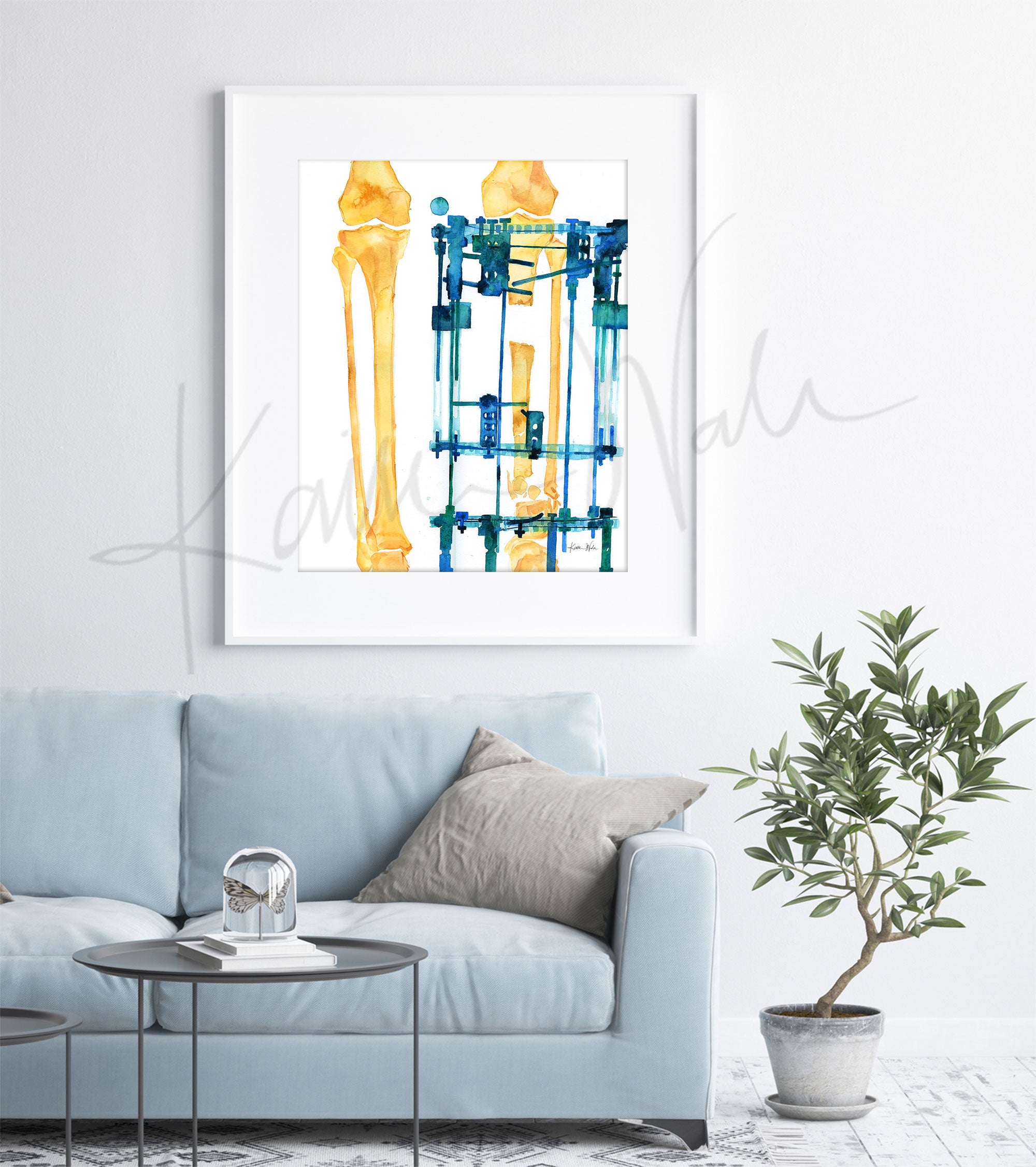 Framed watercolor painting of a post orthopedic surgery x-ray. The painting is hanging over a blue couch.