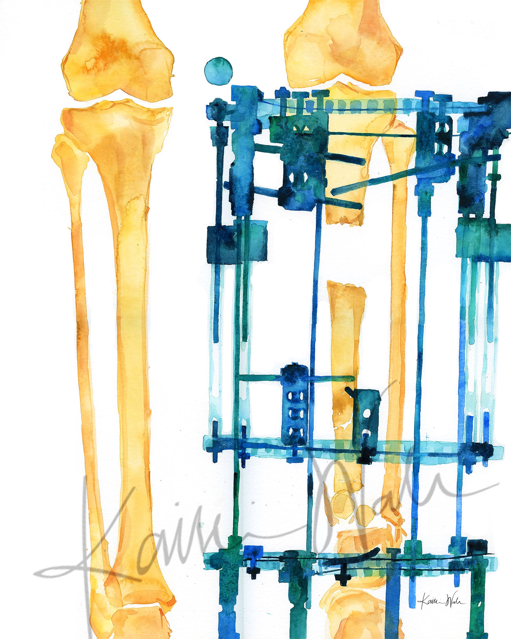 Unframed watercolor painting of a post orthopedic surgery x-ray.