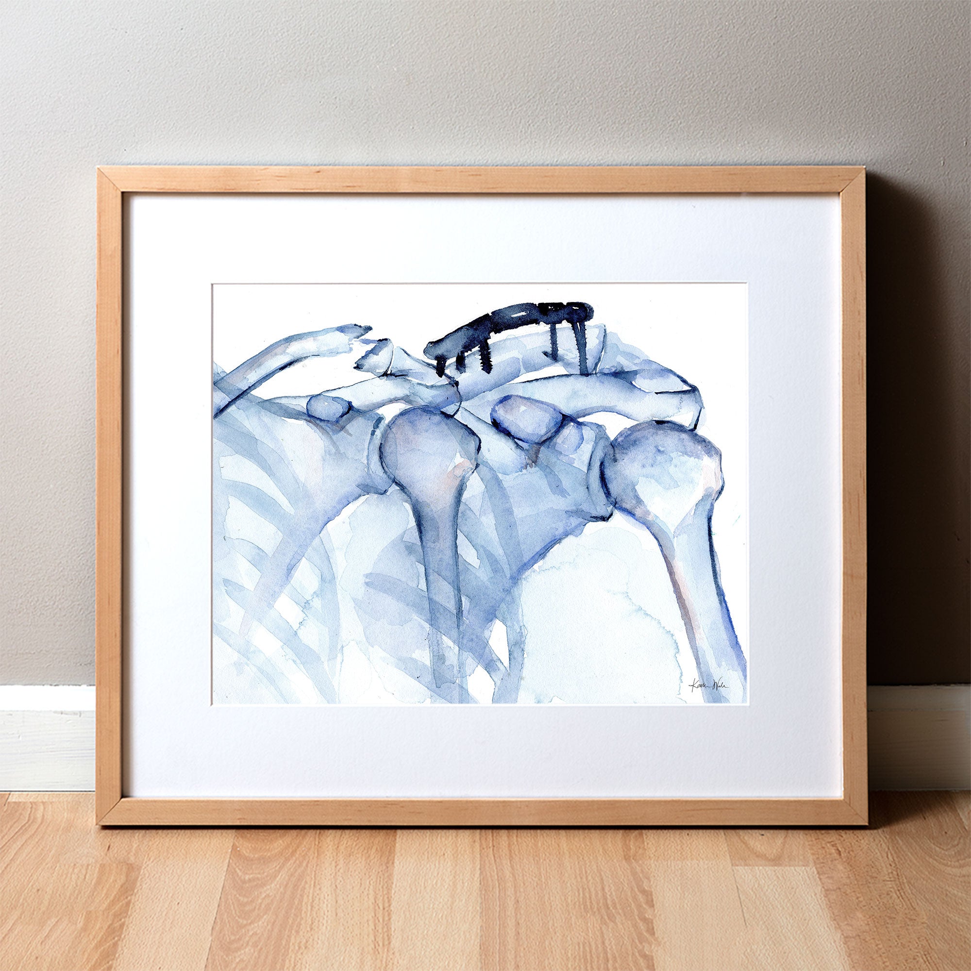 Framed watercolor painting of a before and after of shoulder/clavicle surgery.