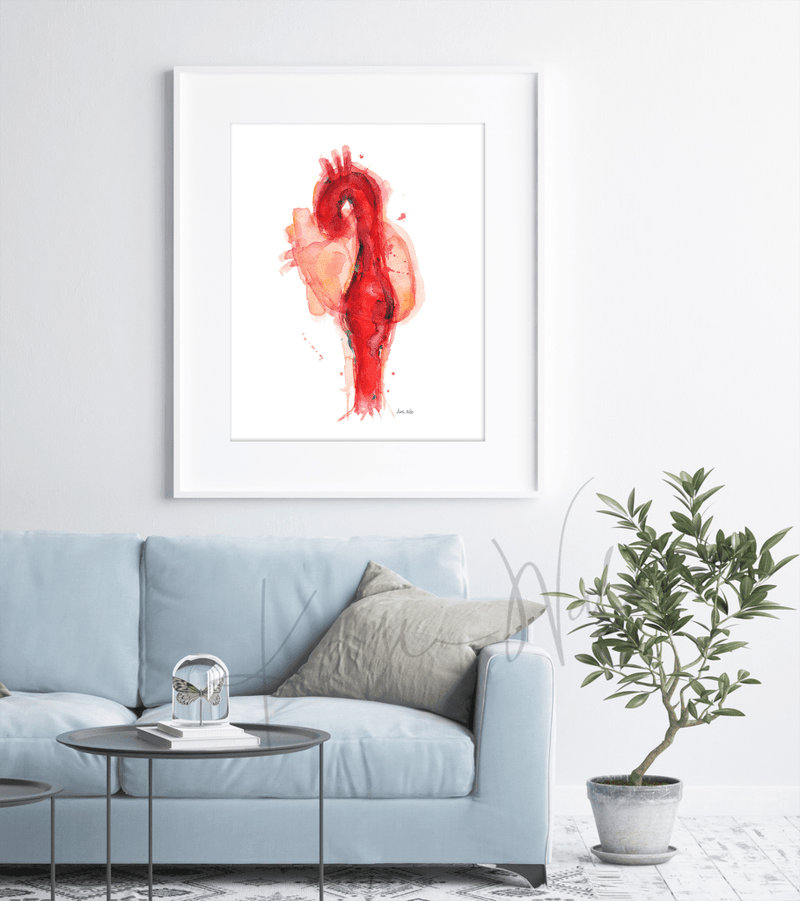 Thoracic Aneurysm Print Watercolor Framed in a Doctor's Office- Home office art- Anatomy Art
