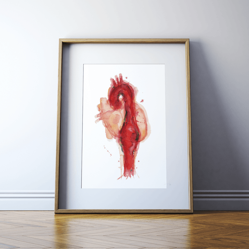Thoracic Aneurysm Print Watercolor- Medical Art- Medical Condition- Anatomy Art- Cardiovascular Art