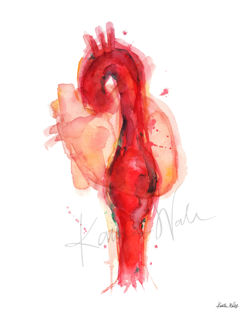 Thoracic Aneurysm Print Watercolor- Gift for Doctor- Gift for Medical Student- Cardiovascular Art- Anatomy Art